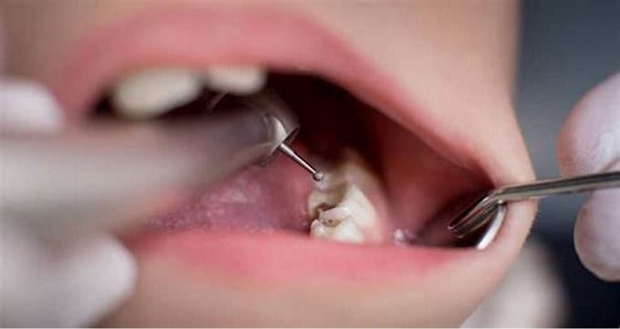 عوارض پر کردن دندان 