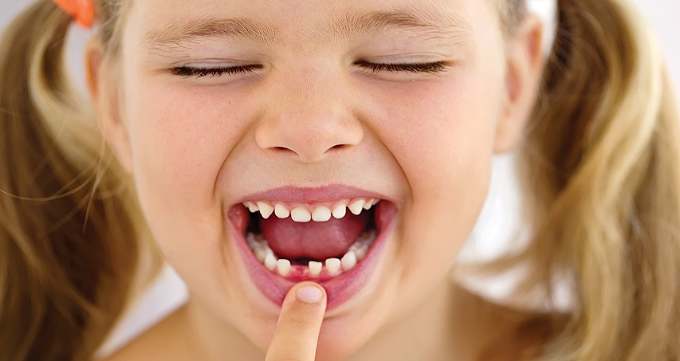 علائم پوسیدگی دندان شیری