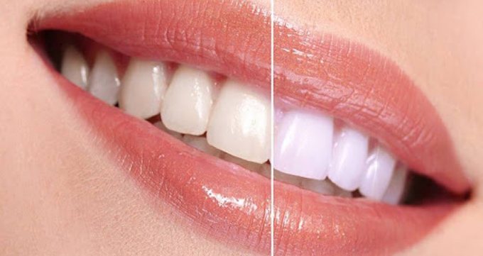 بلیچینگ دندان چگونه است؟