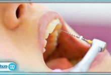 بهترین دندانپزشک درمان ریشه در همدان