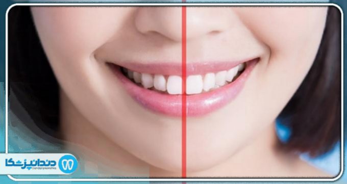 میدیلاین دندان چیست و آیا تعیین میدیلاین دندان اهمیت دارد؟
