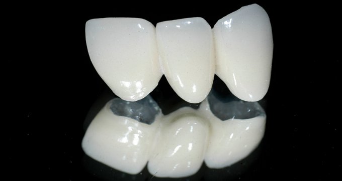 مزایای بریج دندان