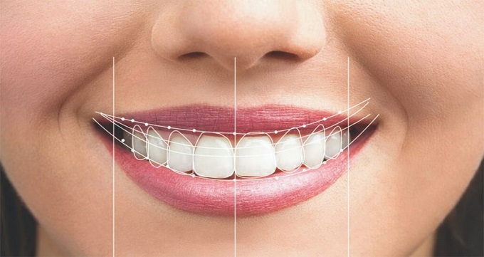 بعد از لمینت دندان چه مراقبت هایی لازم است؟
