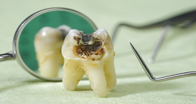 توصیه های بهترین دندانپزشک درمان ریشه در اردبیل
