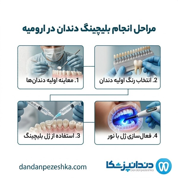 مراحل انجام بلیچینگ دندان در ارومیه