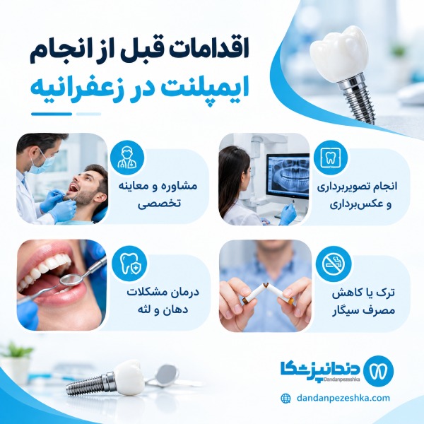 اقدامات قبل از انجام ایمپلنت در زعفرانیه