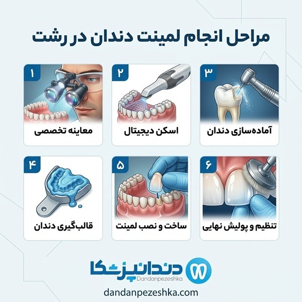 مراحل انجام لمینت دندان در رشت