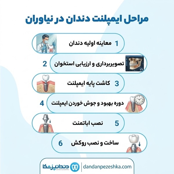 مراحل ایمپلنت دندان در نیاوران