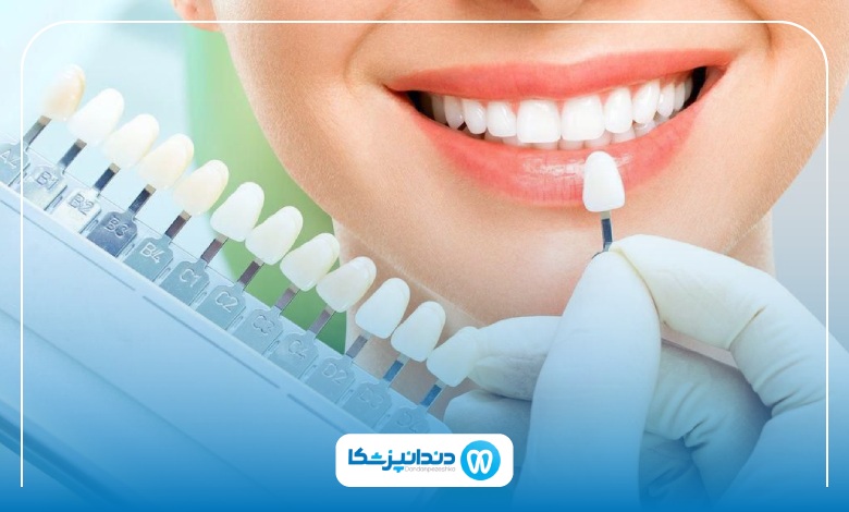 لمینت دندان چگونه انجام می‌شود؟
