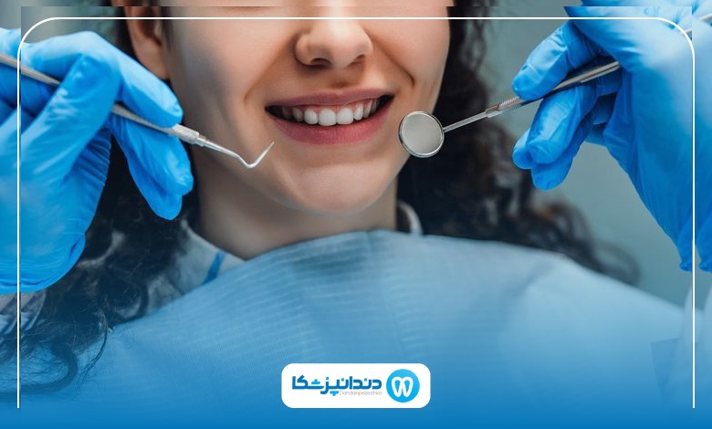 تفاوت کامپوزیت دندان و لمینت دندان