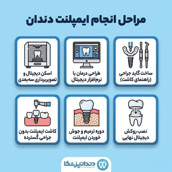 مراحل انجام ایمپلنت دندان