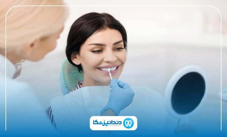 بهترین سن برای لمینت دندان