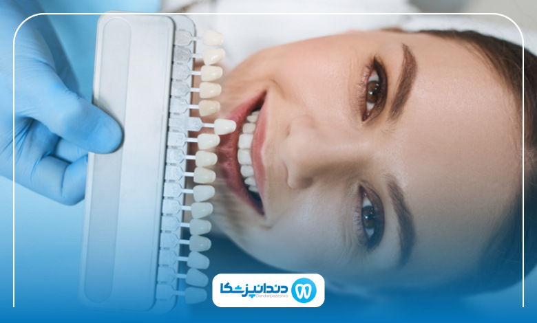 تفاوت لمینت و کامپوزیت دندان