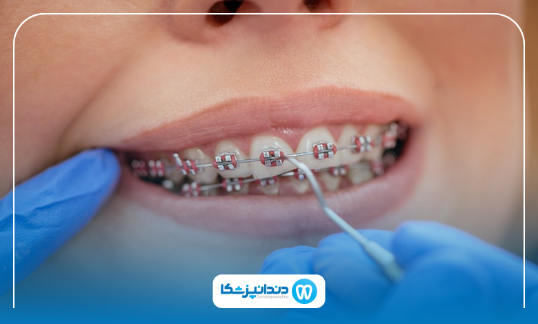 بهترین سن برای شروع درمان ارتودنسی