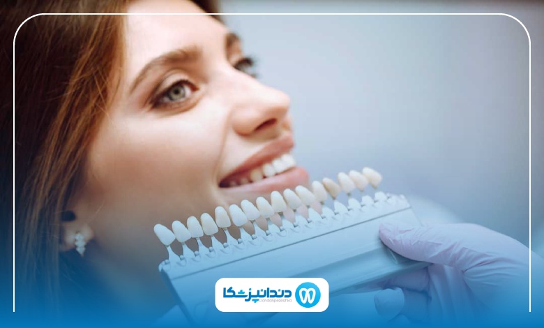 فرق لمینت دیجیتال و لمینت سنتی دندان