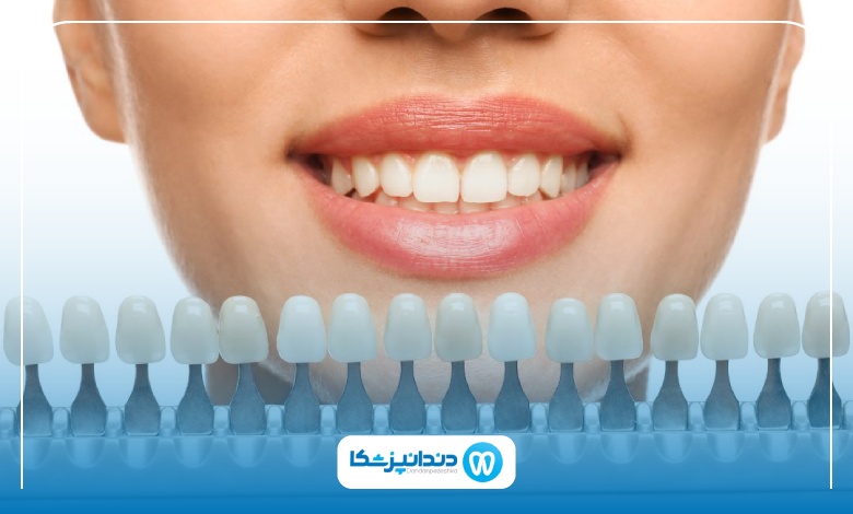 تفاوت لمینت دیجیتال با لمینت معمولی