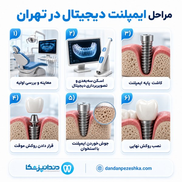 مراحل ایمپلنت دیجیتال در تهران