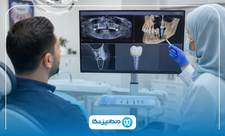 ایمپلنت فوری در تبریز چیست و چه مزایایی دارد؟