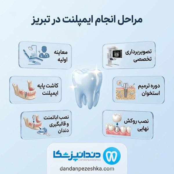 چگونه بهترین دکتر ایمپلنت در تبریز را انتخاب کنیم؟