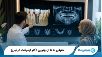 بهترین دکتر ایمپلنت در تبریز