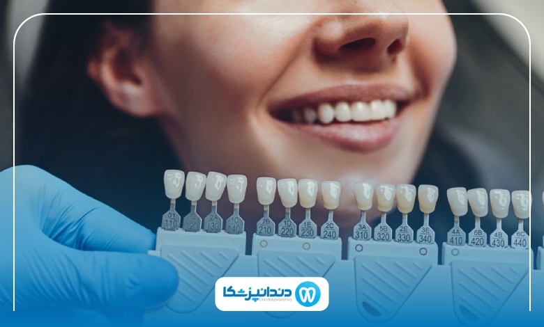 مراحل انجام لمینت دندان در تهران