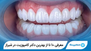 بهترین دکتر کامپوزیت در شیراز
