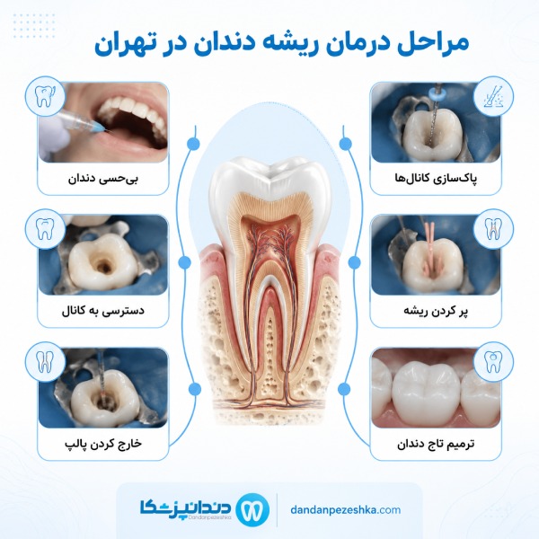 مراحل درمان ریشه دندان در تهران