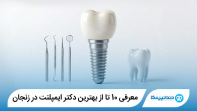 بهترین دکتر ایمپلنت در زنجان