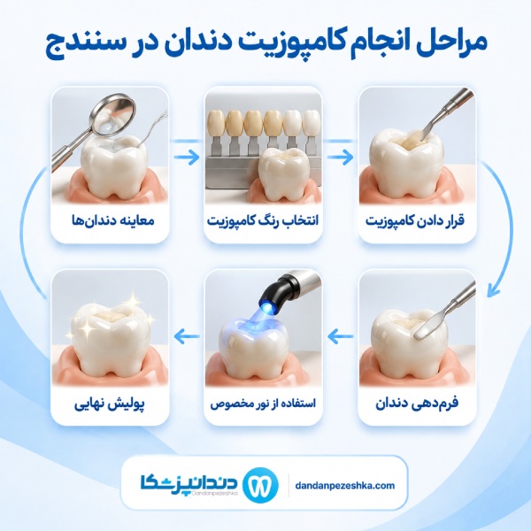 مراحل انجام کامپوزیت دندان در سنندج