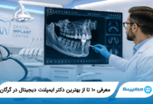 بهترین دکتر ایمپلنت دیجیتال در گرگان
