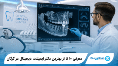 بهترین دکتر ایمپلنت دیجیتال در گرگان