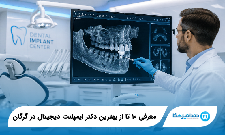 بهترین دکتر ایمپلنت دیجیتال در گرگان