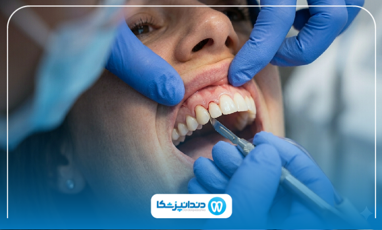 بهترین دکتر لیفت لثه در آمل