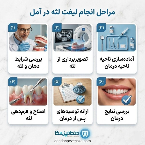 مراحل انجام لیفت لثه در آمل