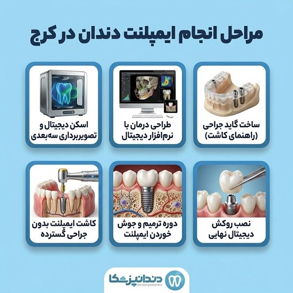 مراحل انجام ایمپلنت دندان در کرج