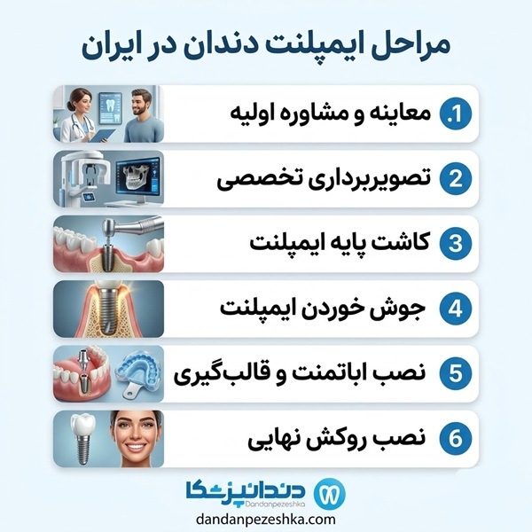 مراحل ایمپلنت دندان در ایران