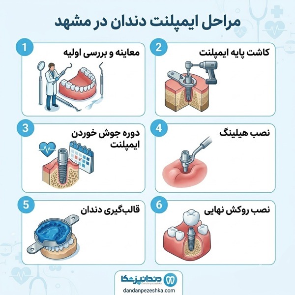 مراحل ایمپلنت دندان در مشهد