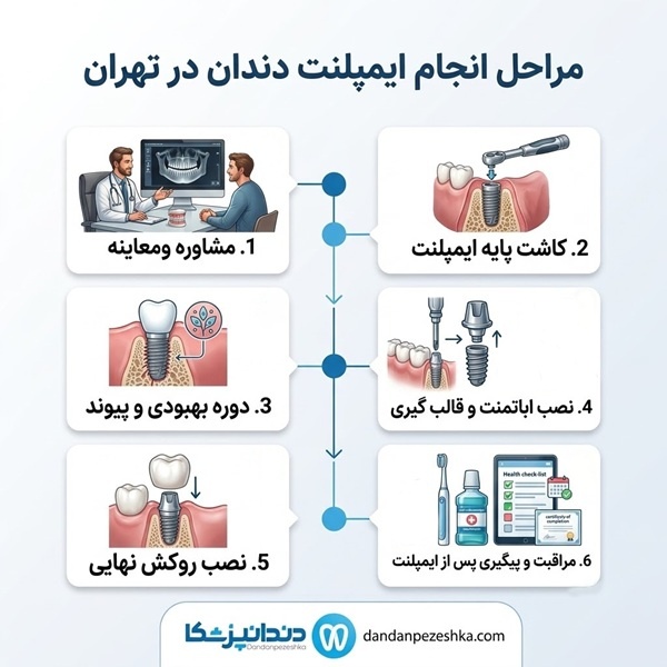مراحل انجام ایمپلنت دندان در تهران