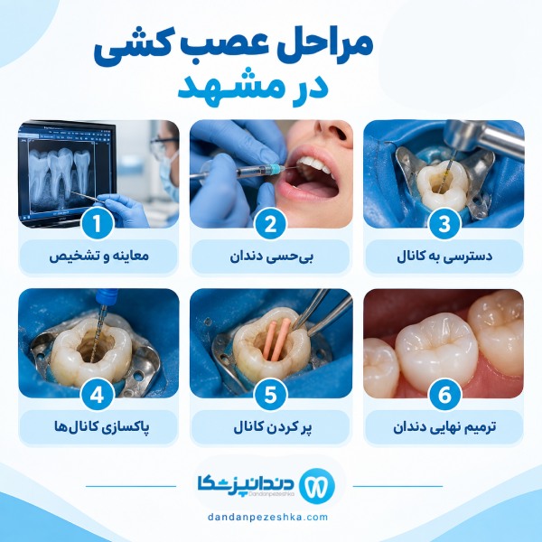 مراحل عصب کشی در مشهد