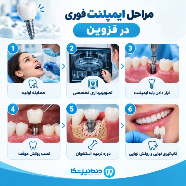مراحل ایمپلنت فوری در قزوین