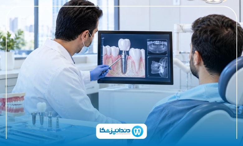 چه کسانی کاندید ایمپلنت فوری هستند؟